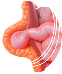 hernia
